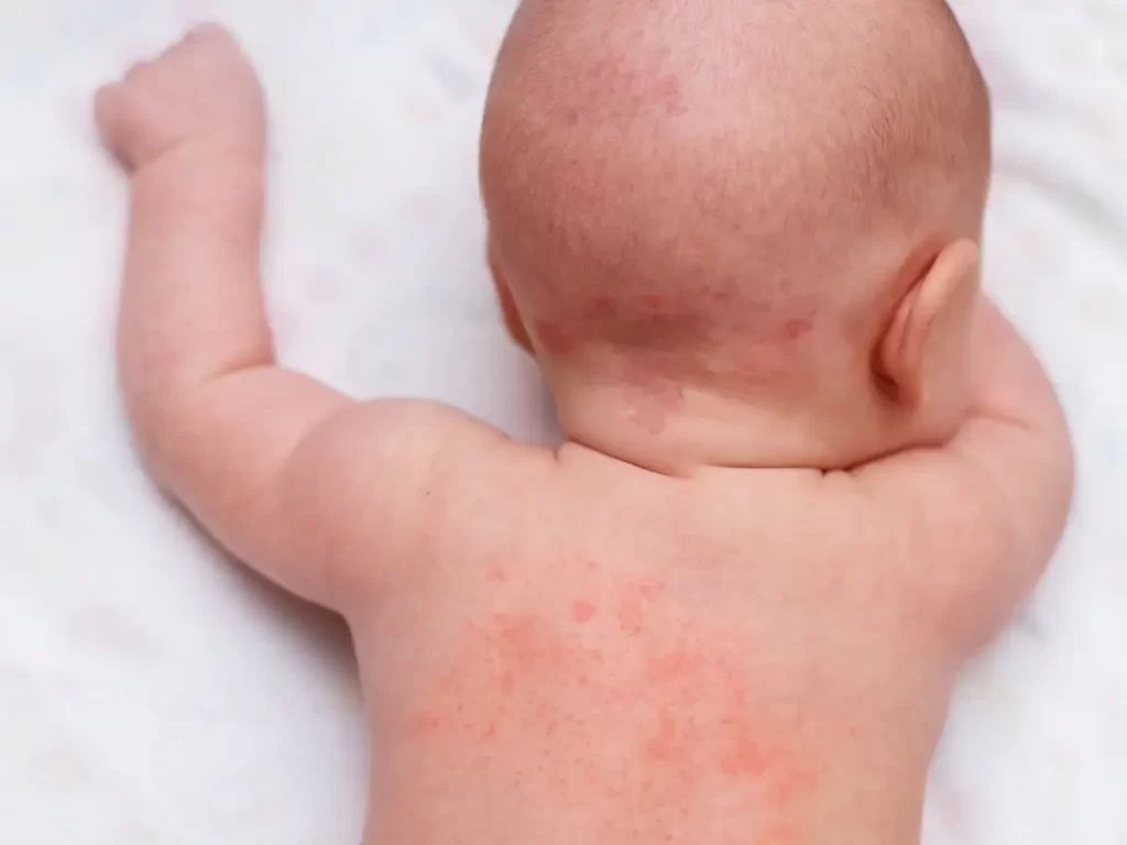 Baby’s Rash