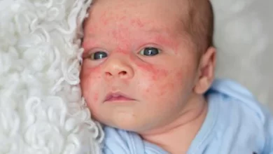 Baby’s Rash